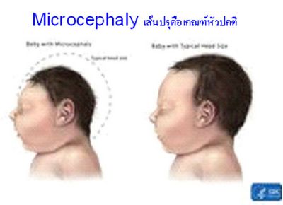 Microcephaly คืออะไร?